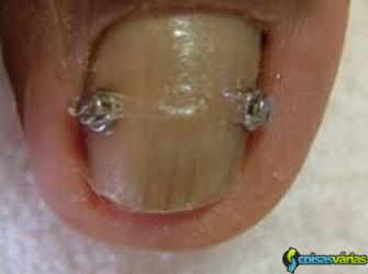 Curso onicoórtese ungueal - tratamento de unhas encravadas