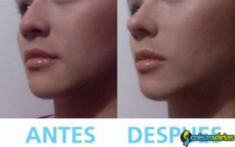Distribuidores de produto inovador: corretores nasais premium / nariz perfeito