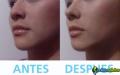 Distribuidores de produto inovador: corretores nasais premium / nariz perfeito 1